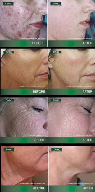 DMK facials Melbourne