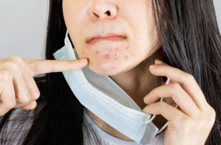 How to fight ‘Maskne’