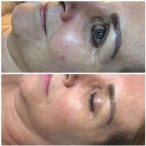 Dermafrac is completely safe for all skin types
