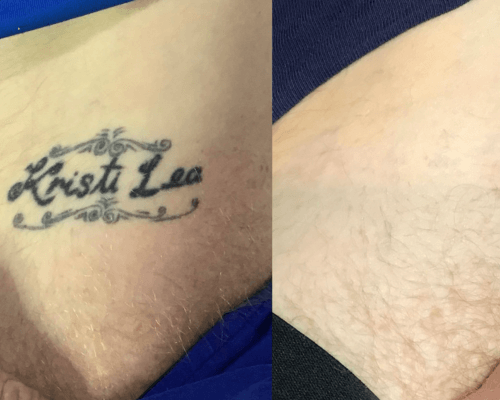 before and after tattoo name removal richmond skin and laser melbourne