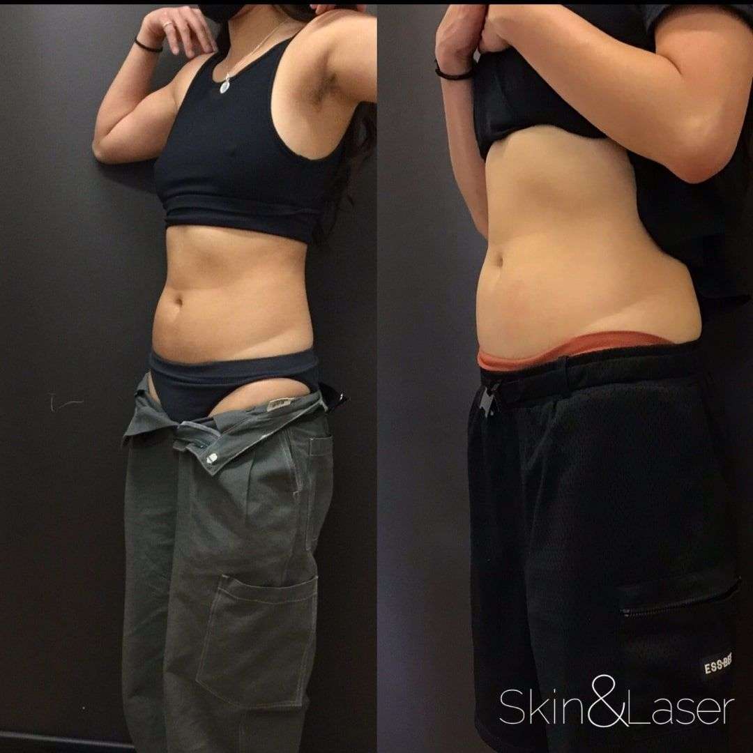 SculpSure