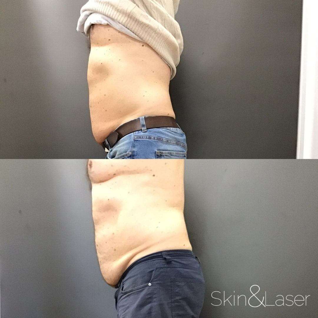 SculpSure