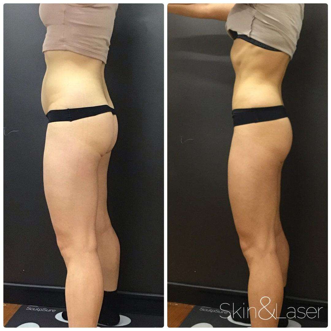 SculpSure