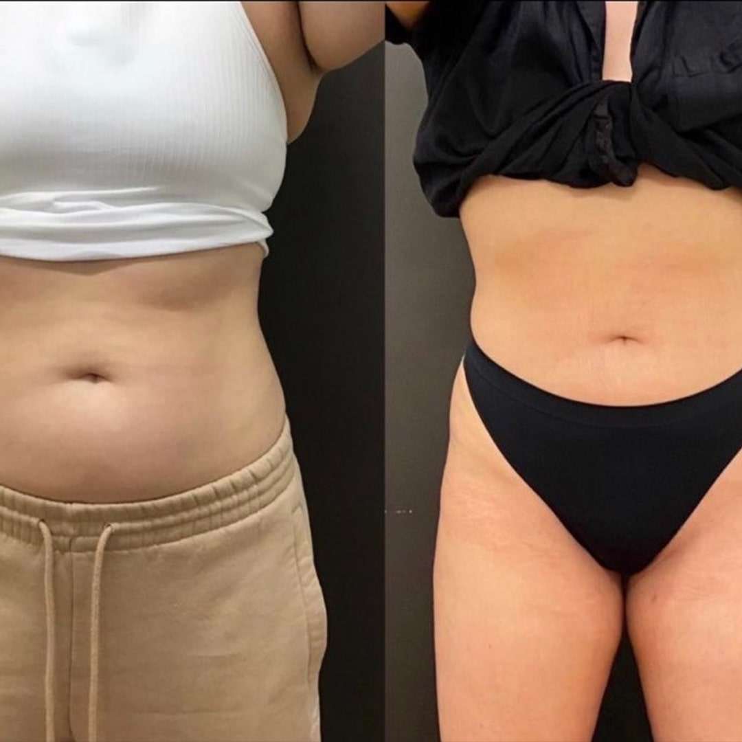 SculpSure Before & Afters