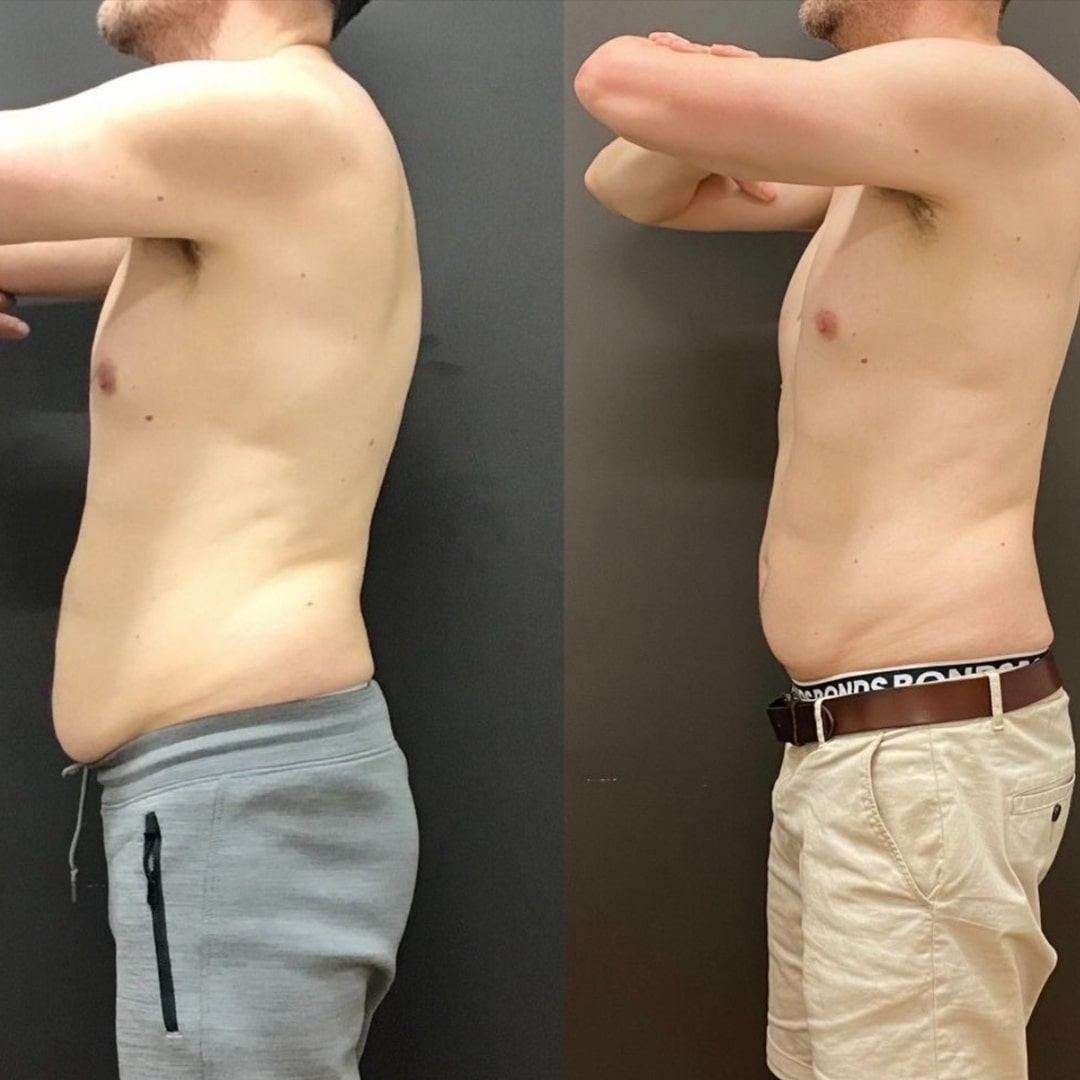 SculpSure