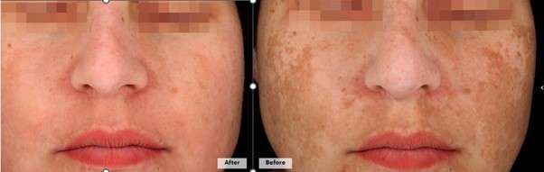 before and after
