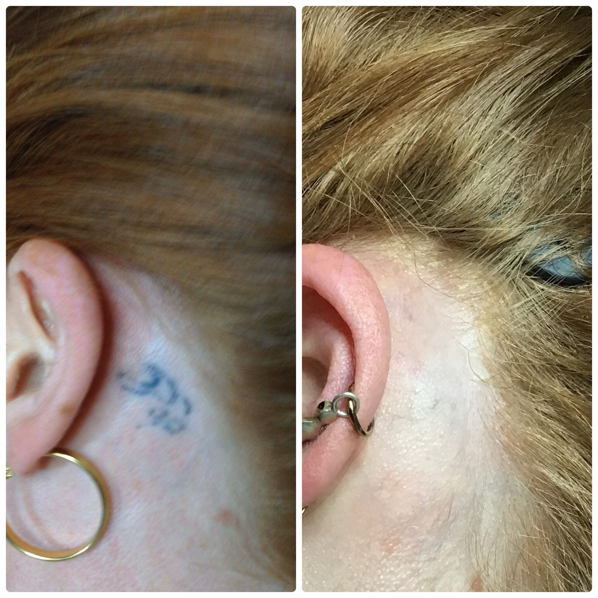 picosure laser tattoo removal melbourne