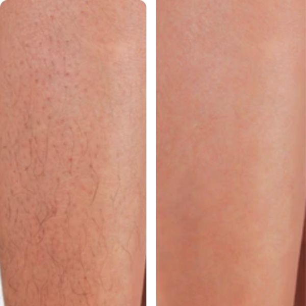 laser hair removal melbourne