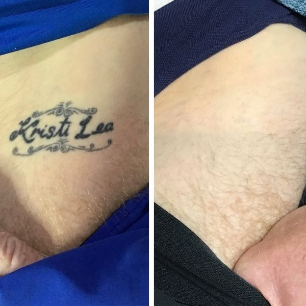 laser tattoo removal melbourne before after