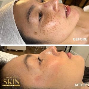 hyperpigmentation treatment before after
