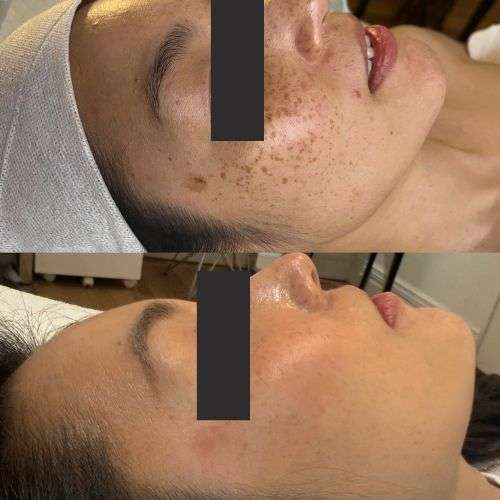 melasma before and after_richmond skin and laser clinic