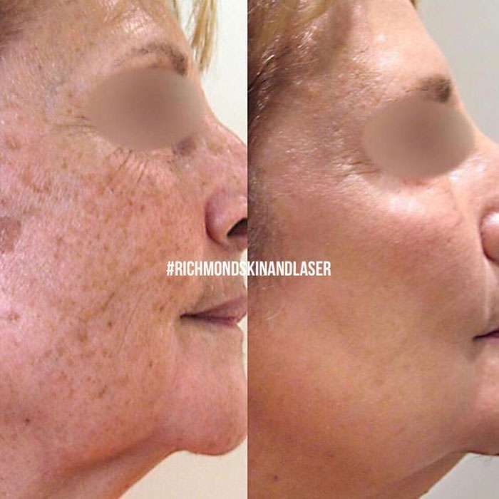 Picosure-Skin-Rejuvenation-before-and-afters-3