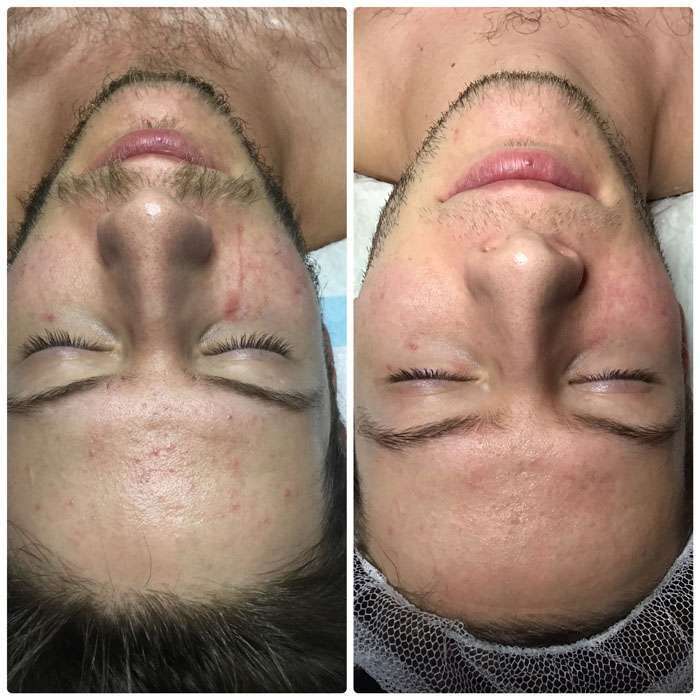 Skin-Needling-Factor4-Before-Afters-3