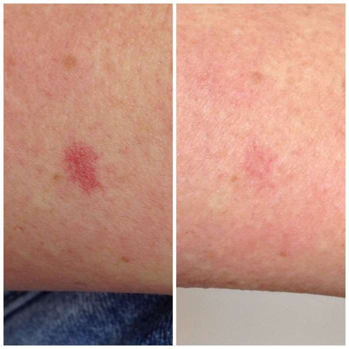 Vascular-Rejuvenation-Before-Afters-1