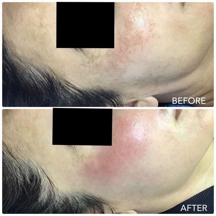 Cosmelan Before and After