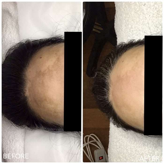 Cosmelan Before and After 2