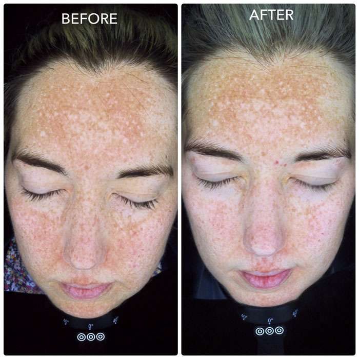 Cosmelan Before and After 3
