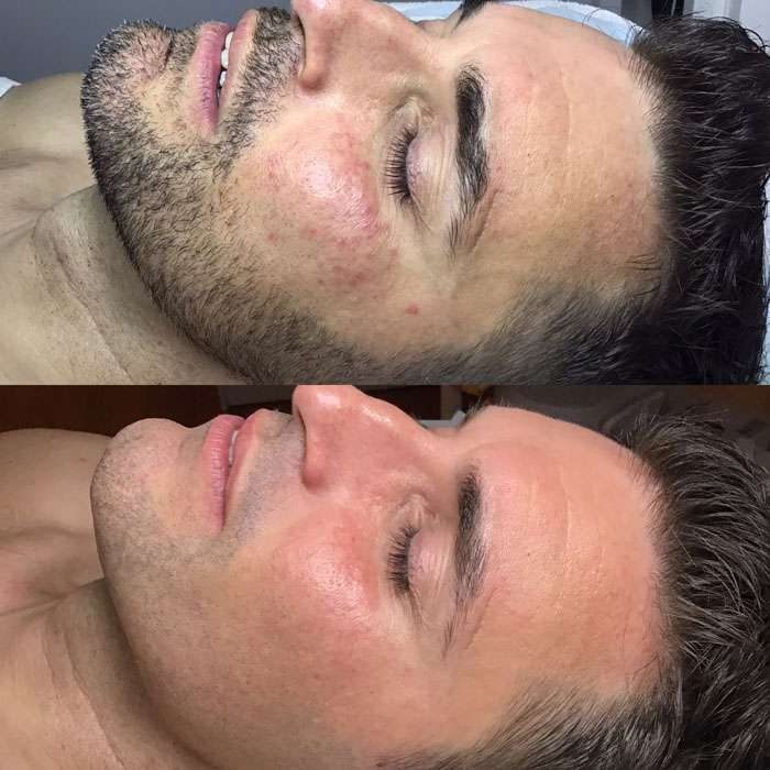 DMK Skin Before & Afters