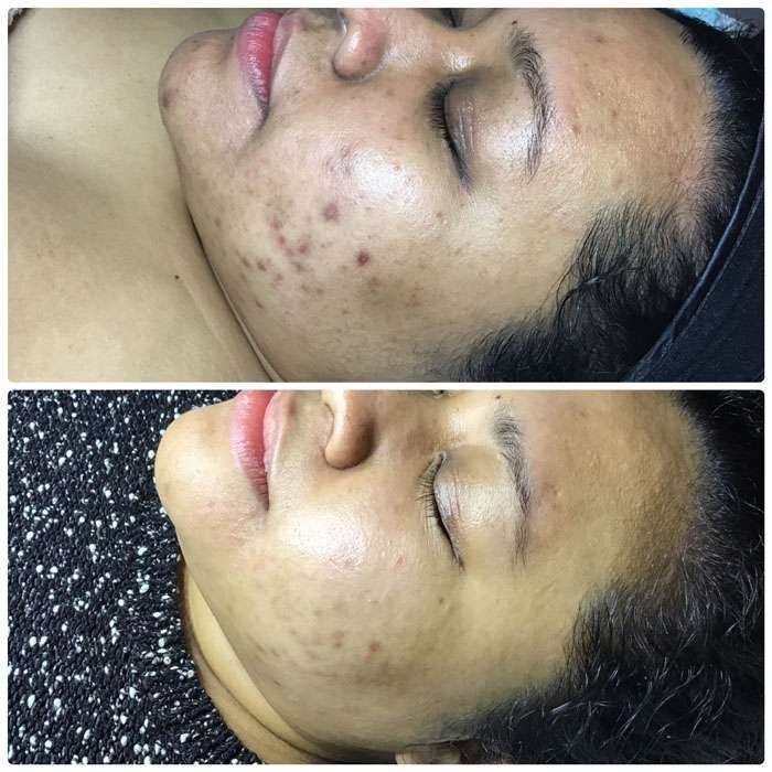 DMK Skin Before & Afters 2