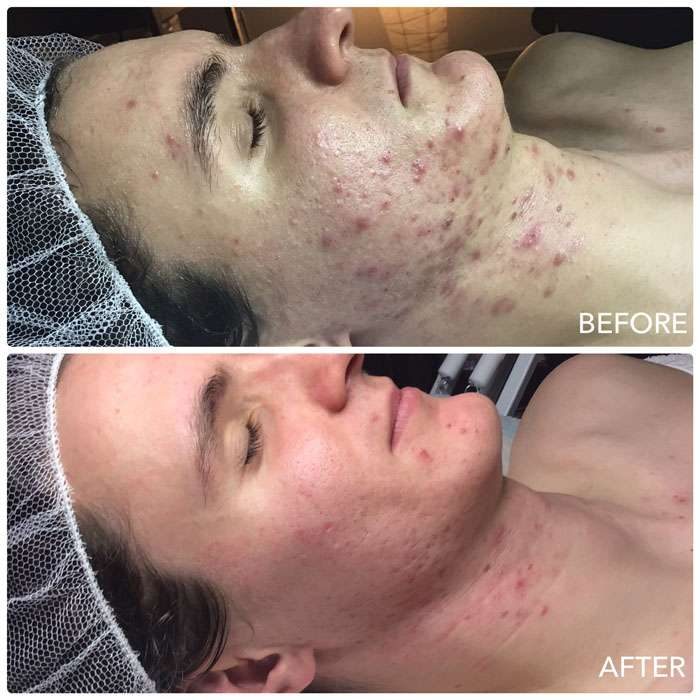 DMK Skin Before & Afters 3
