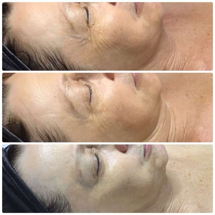 DMK Skin Before & Afters 4