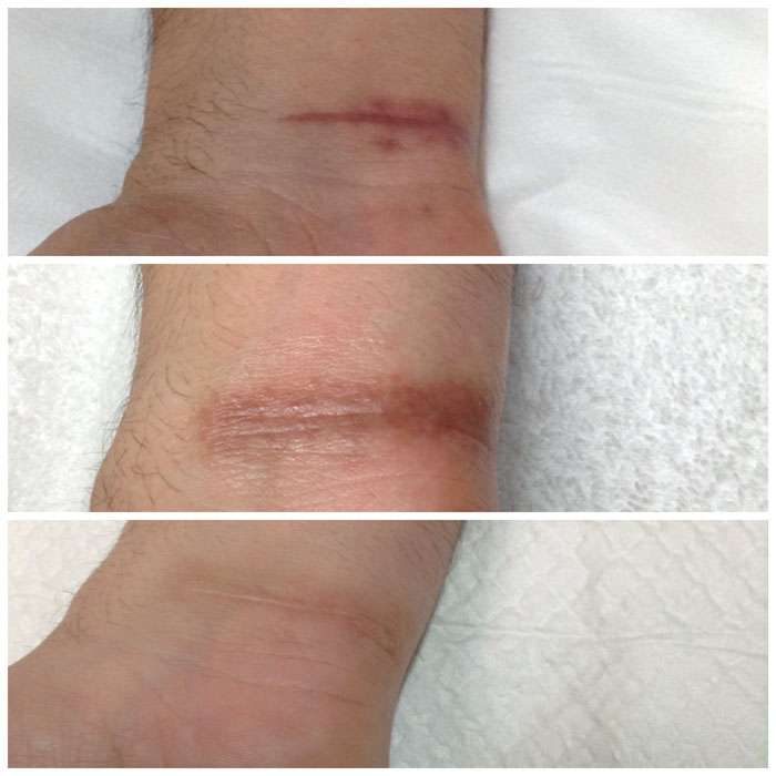 Picosure Skin Rejuvenation before and afters