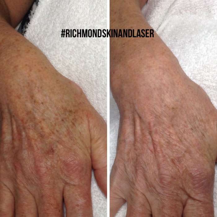 Picosure Skin Rejuvenation before and afters 2