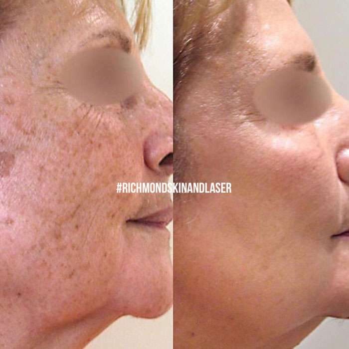 Picosure Skin Rejuvenation before and afters 3