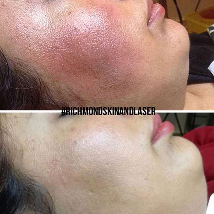 Picosure Skin Rejuvenation before and afters 4