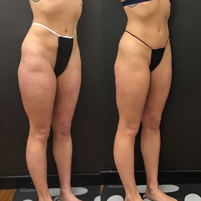 SculpSure Before & Afters