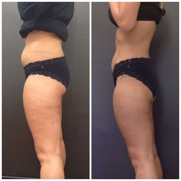 SculpSure Before & Afters 2