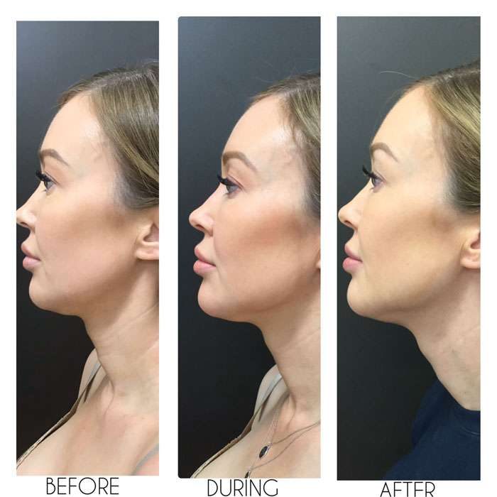 SculpSure Before & Afters 3