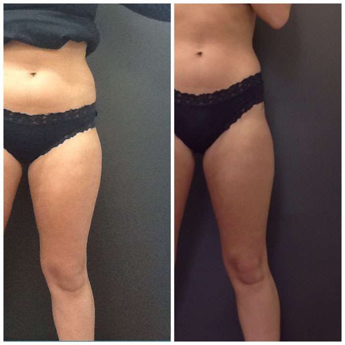 SculpSure Before & Afters 4