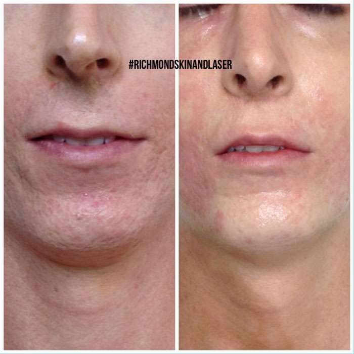 Skin Needling & Factor4 Before & Afters