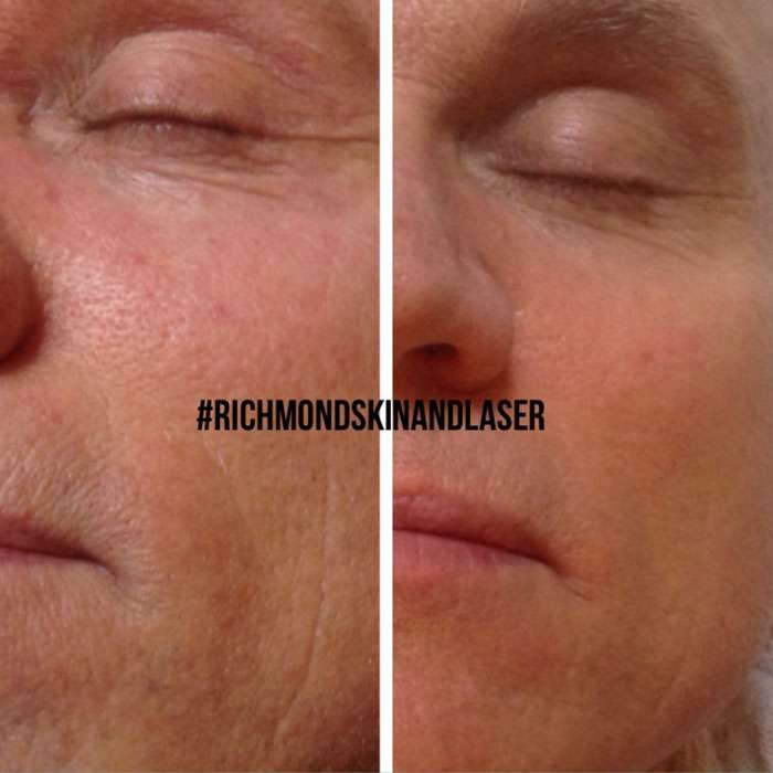 Skin Needling & Factor4 Before & Afters 2