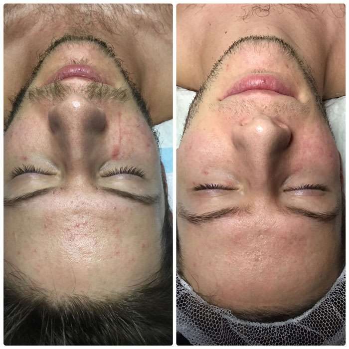Skin Needling & Factor4 Before & Afters 3