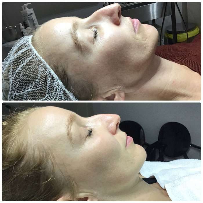 Skin Needling & Factor4 Before & Afters 4