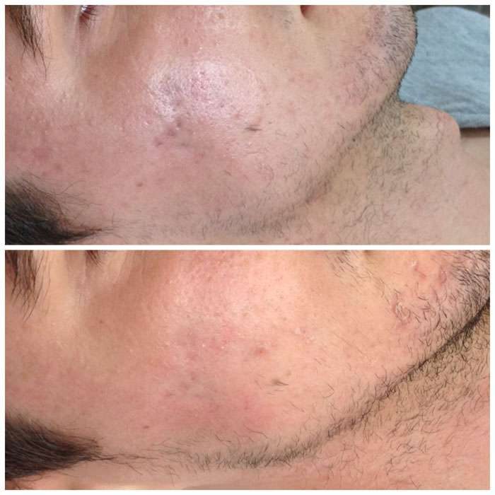 Skin Needling & Factor4 Before & Afters 5