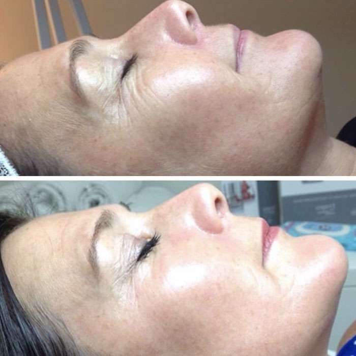 Skin Needling & Factor4 Before & Afters 6