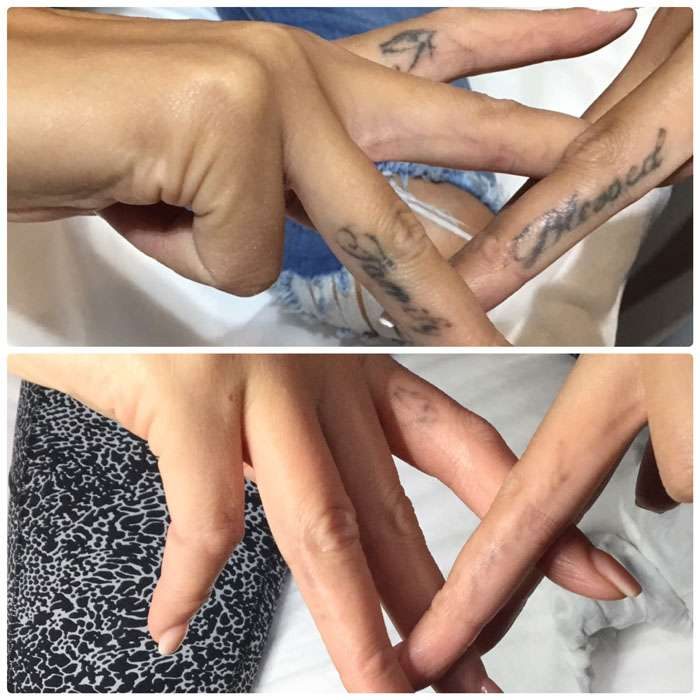 Tattoo Removal Before & Afters