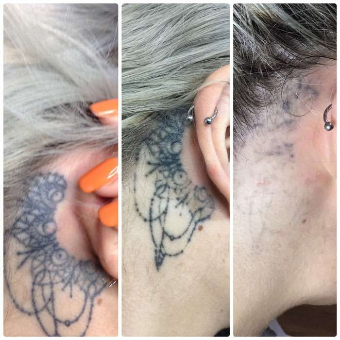 Tattoo Removal Before & Afters 2