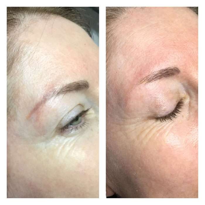 Tattoo Removal Before & Afters 3