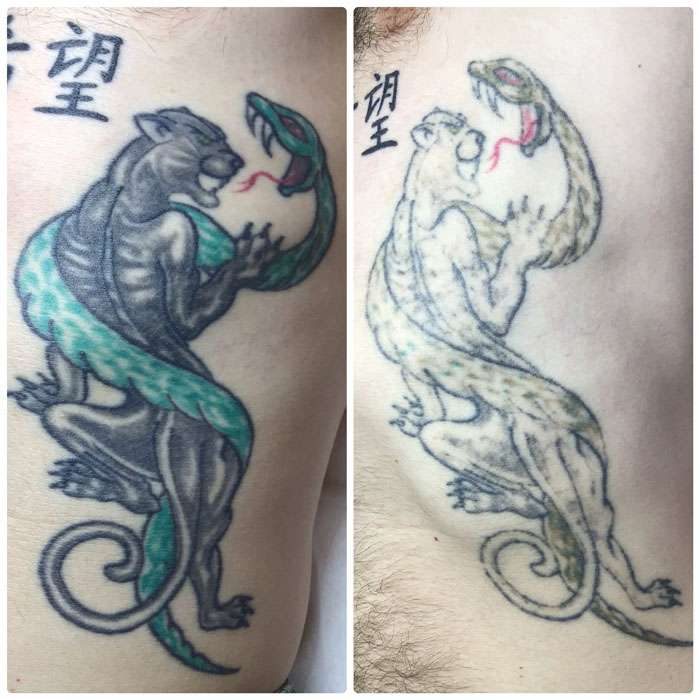Tattoo Removal Before & Afters 4