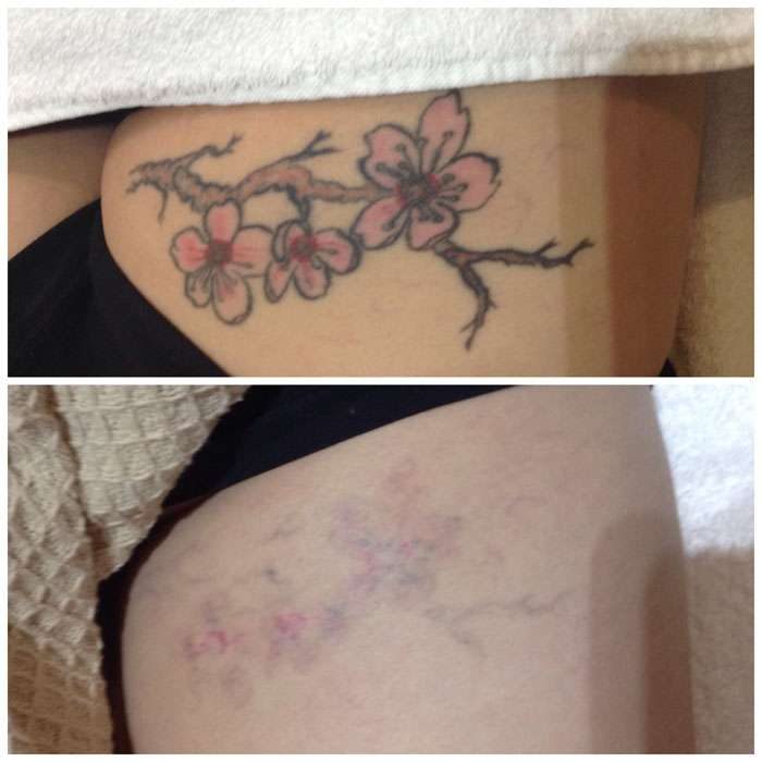 Tattoo Removal Before & Afters 5