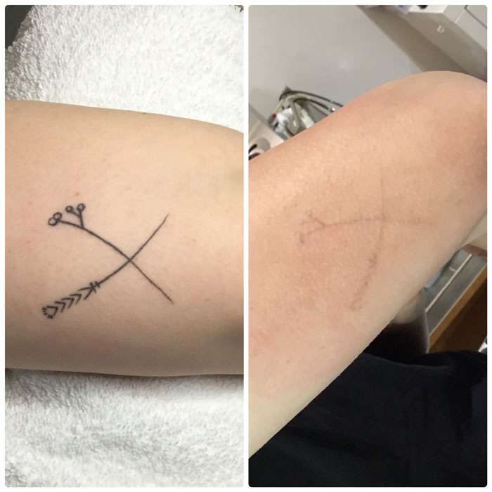 Tattoo Removal Before & Afters 6