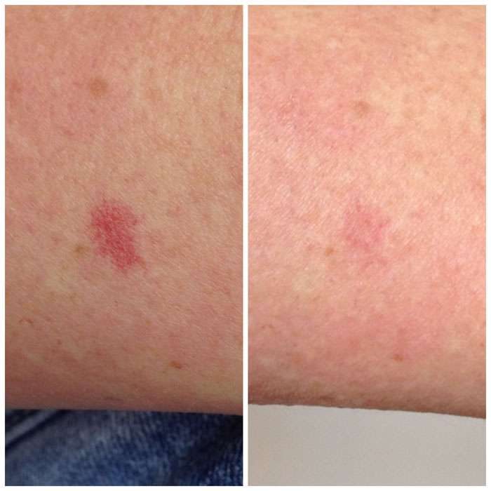Vascular Rejuvenation Before & Afters