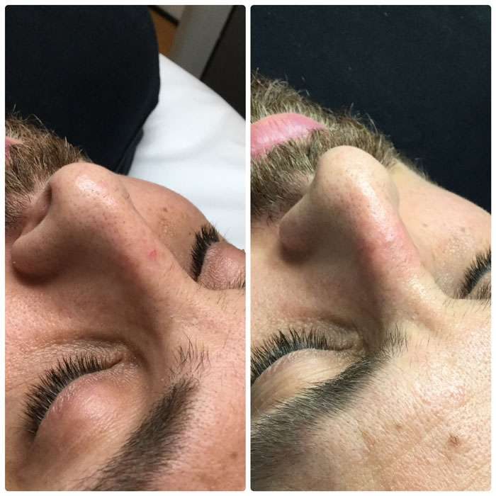 Vascular Rejuvenation Before & Afters 2